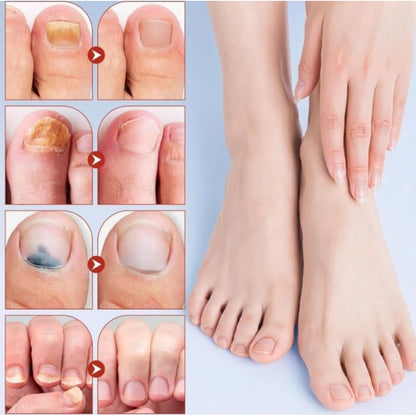 Generic Fungal Nail Patches (Yellow)